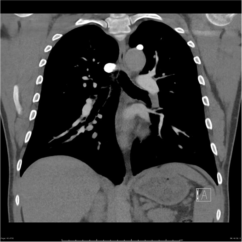 Azygos venous system anatomy (CT pulmonary angiography) (Radiopaedia 25928-26077 Coronal C+ CTPA 45).jpg