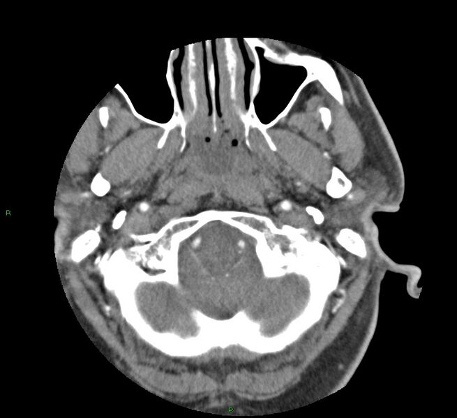 File:Basal ganglia hemorrhage (Radiopaedia 58763-65985 D 21).jpg