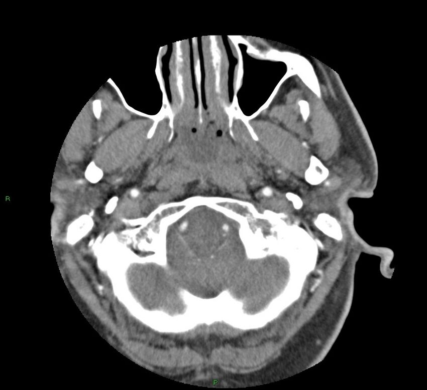 Basal ganglia hemorrhage (Radiopaedia 58763-65985 D 21).jpg