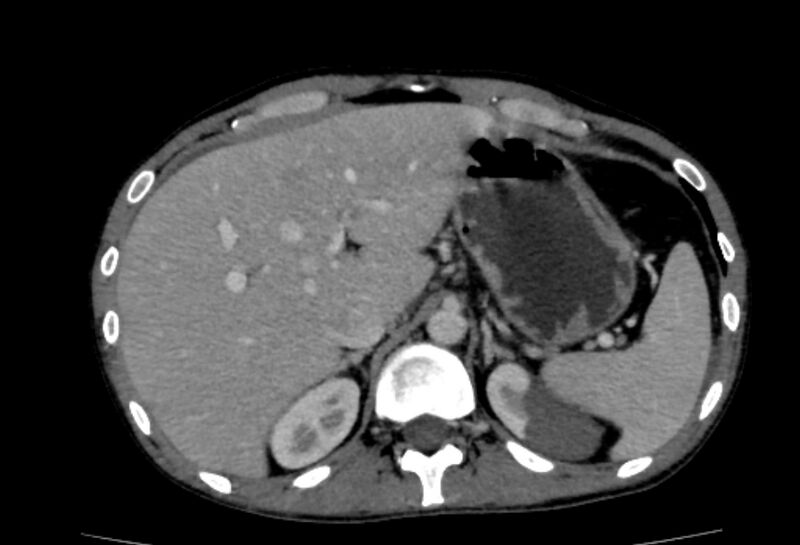 File:Behçet's disease- abdominal vasculitis (Radiopaedia 55955-62570 A 14).jpg