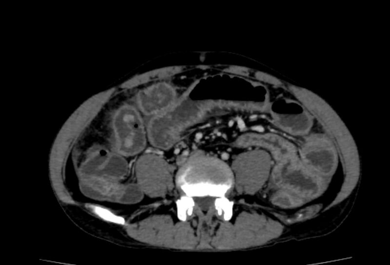 File:Behçet's disease- abdominal vasculitis (Radiopaedia 55955-62570 A 53).jpg