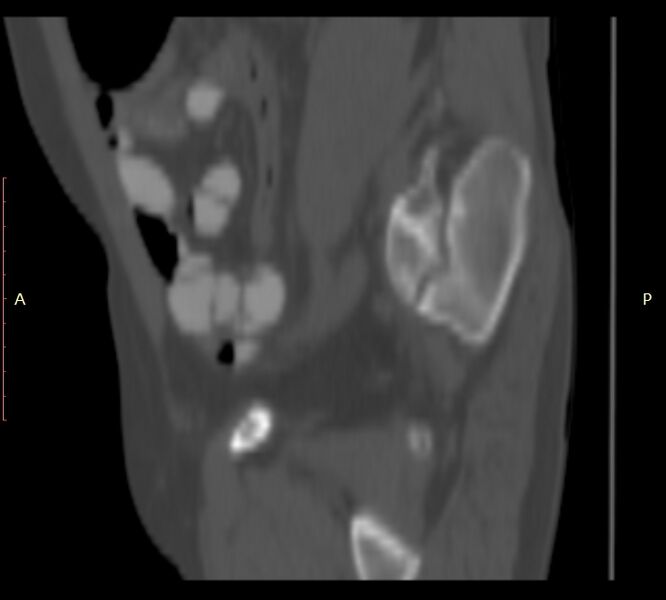 File:Bertolotti syndrome (Radiopaedia 58974-66235 Sagittal bone window 51).jpg