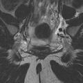 Bicornuate uterus (Radiopaedia 24677-24949 Coronal T2 14).jpg