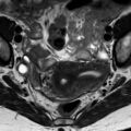 Bicornuate uterus (Radiopaedia 61974-70046 Axial T2 3).jpg