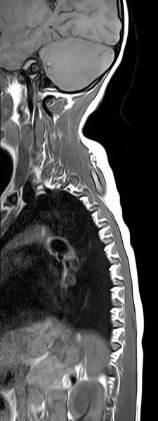 File:Bilateral Sprengel deformity with Klippel-Feil syndrome (Radiopaedia 66395-75650 Sagittal T1 12).jpg