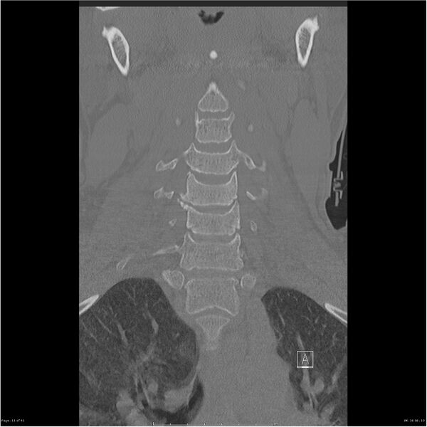File:Bilateral cervical ribs (Radiopaedia 25868-26017 Coronal bone window 11).jpg