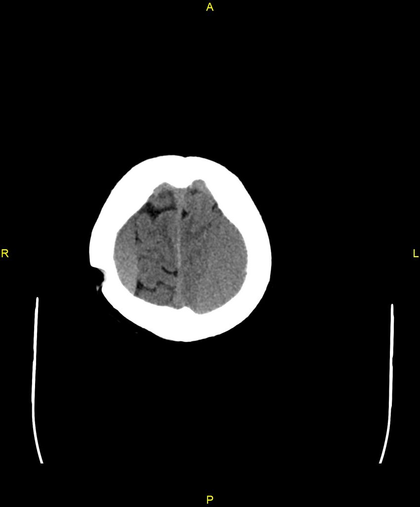 Bilateral isodense subdural hematomas (Radiopaedia 88621-105325 Axial non-contrast 99).jpg