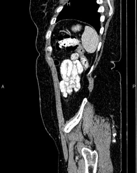File:Bilateral ovarian serous cystadenocarcinoma (Radiopaedia 86062-101989 E 77).jpg