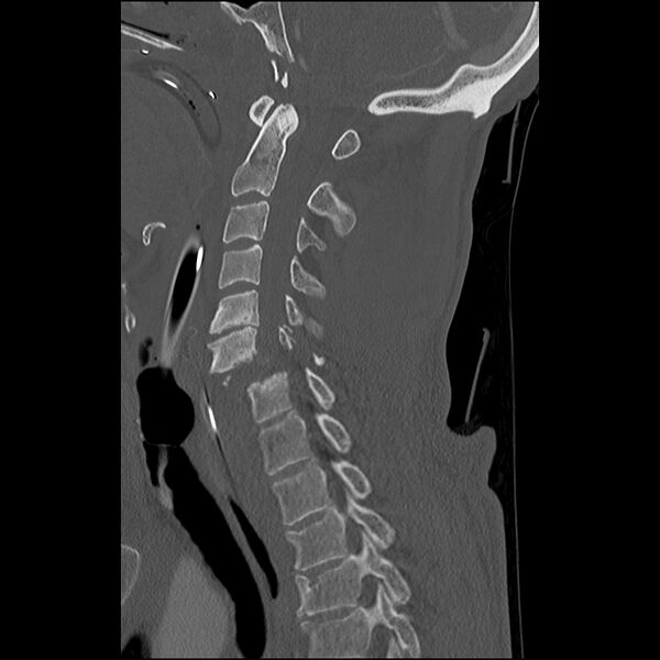 File:Bilateral perched facets with cord injury (Radiopaedia 45587-49713 Sagittal bone window 24).jpg