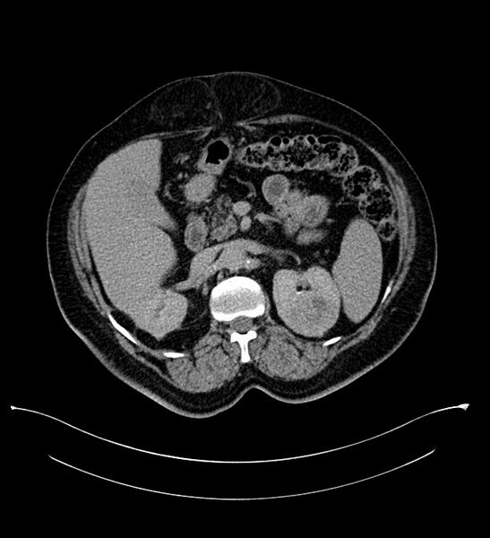 File:Bilateral sporadic synchronous clear cell renal cell carcinoma (Radiopaedia 85035-100575 H 29).jpg