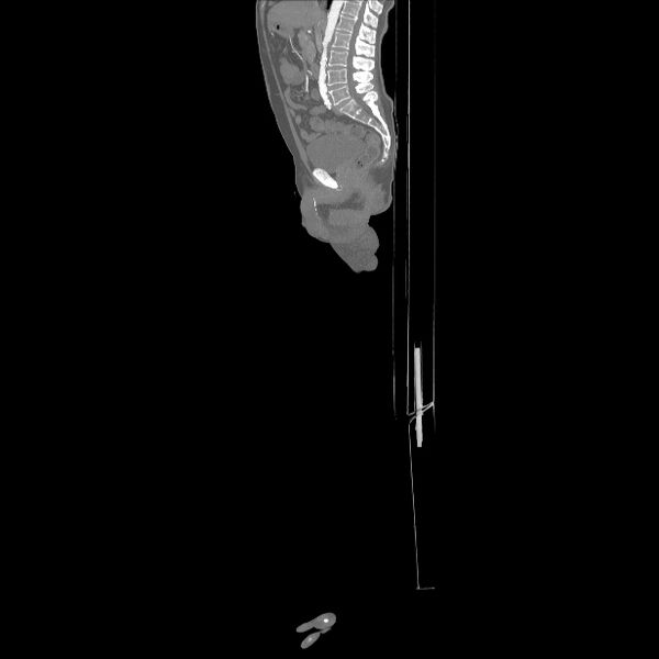 File:Bilateral superficial femoral arterial occlusion (Radiopaedia 25682-25857 MIP 22).jpg