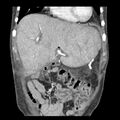 Biliary necrosis - liver transplant (Radiopaedia 21876-21846 C 10).jpg