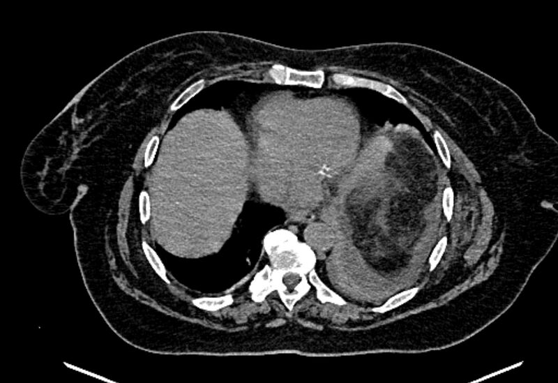 File:Biliary pancreatitis (Radiopaedia 72289-82823 Axial non-contrast 23).jpg
