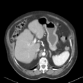 Bladder papillary urothelial carcinoma (Radiopaedia 48119-52951 A 11).png