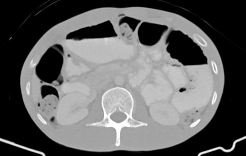 File:Blunt injury to the small bowel (Radiopaedia 74953-85987 Axial Wide 32).jpg