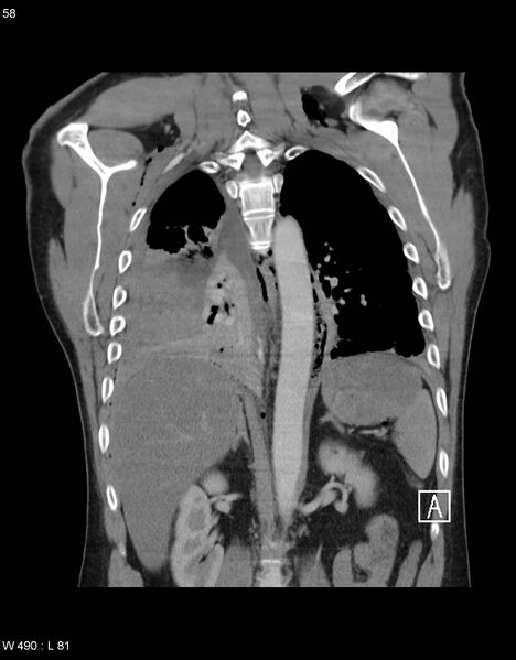 File:Boerhaave syndrome with tension pneumothorax (Radiopaedia 56794-63605 B 24).jpg