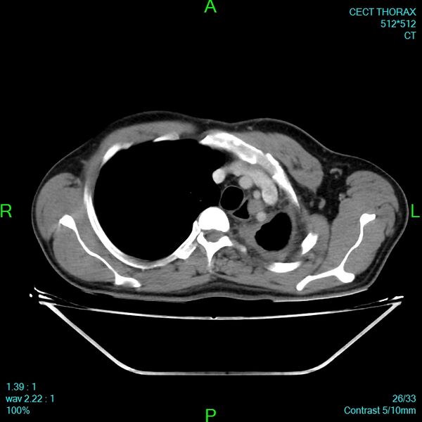 File:Bone metastases from lung carcinoma (Radiopaedia 54703-60937 Axial C+ delayed 26).jpg