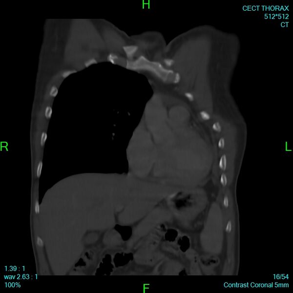 File:Bone metastases from lung carcinoma (Radiopaedia 54703-60937 Coronal bone window 16).jpg