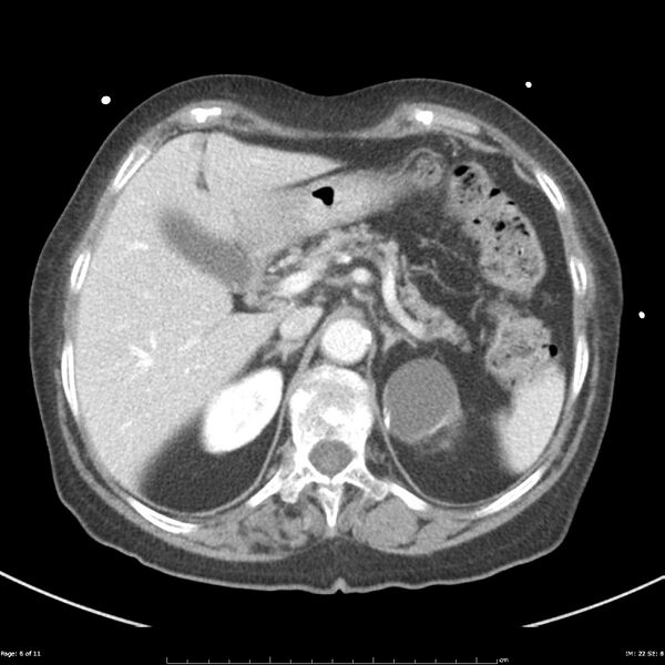 File:Bosniak renal cyst - type IIF (Radiopaedia 23385-23450 A 6).jpg