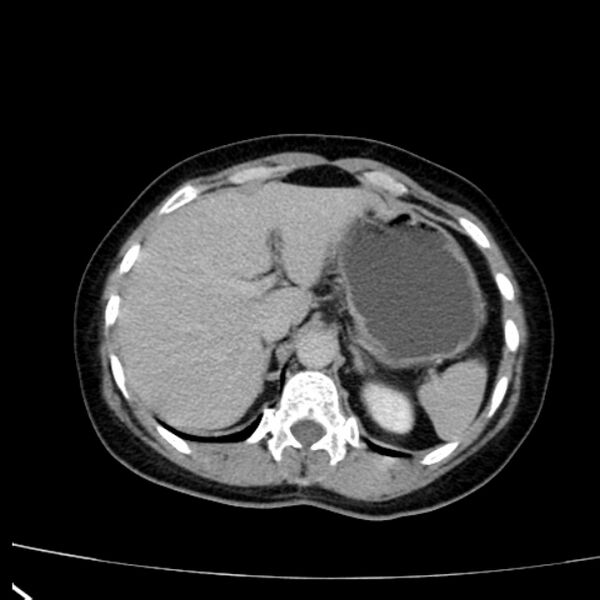 File:Bosniak renal cyst - type I (Radiopaedia 27479-27675 D 3).jpg