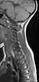 Brachial plexus birth palsy (Radiopaedia 68118-77604 Sagittal T1 5).jpg