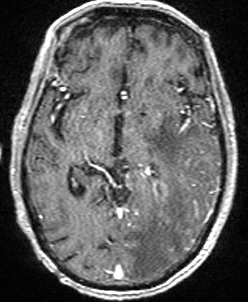 File:Brain abscess with dual rim sign (Radiopaedia 87566-103938 Axial T1 C+ 79).jpg