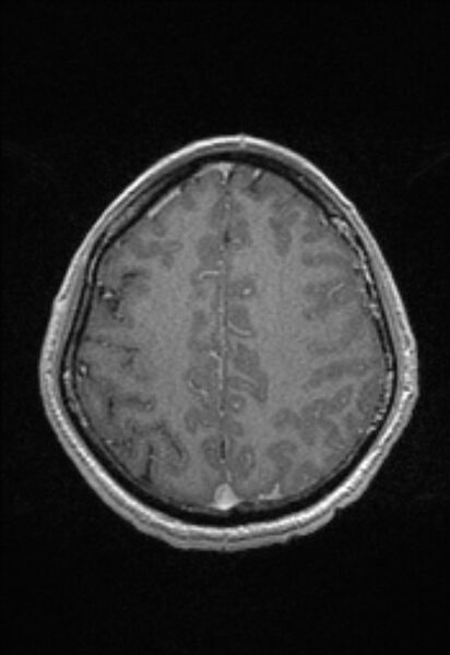 File:Brain abscess with ventriculitis (Radiopaedia 85703-101495 Axial T1 C+ 131).jpg