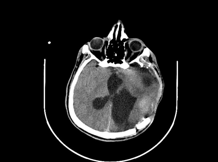 Brain injury by firearm projectile (Radiopaedia 82068-96088 A 126).jpg