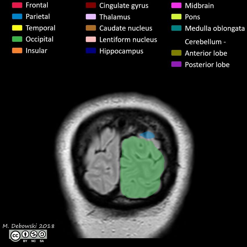 Brain lobes - annotated MRI (Radiopaedia 61691-69700 Coronal 71).JPG
