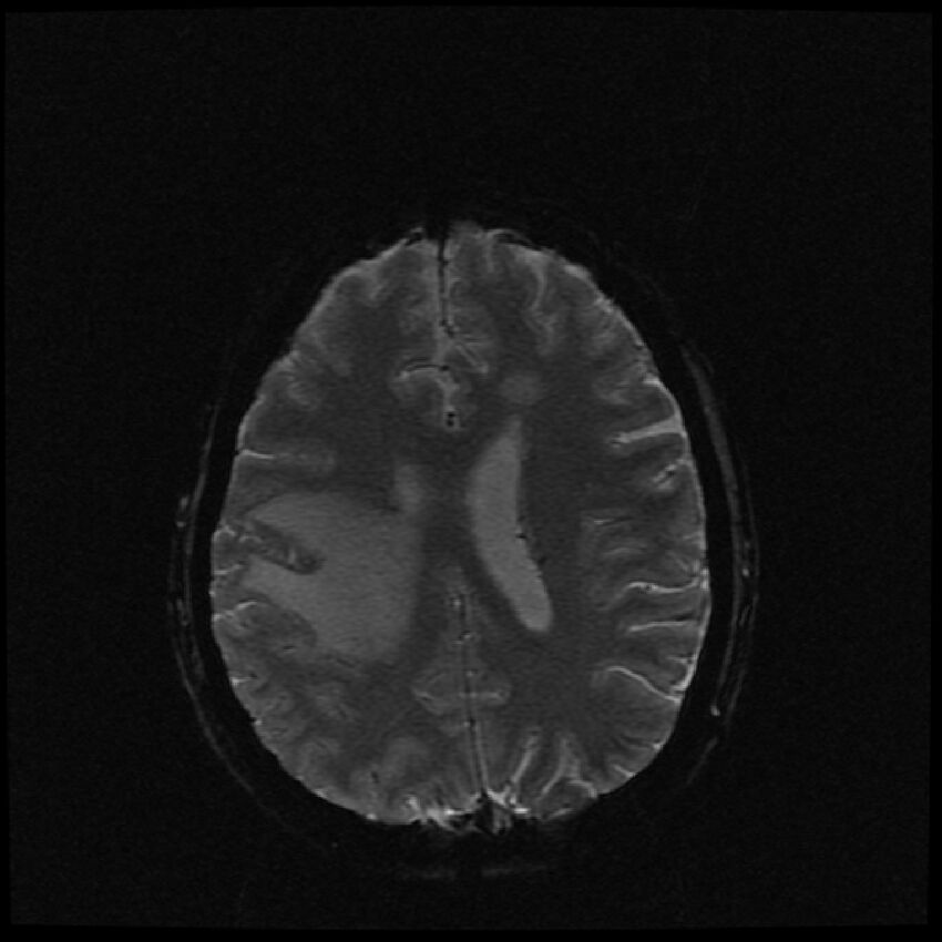 Brain metastases (renal cell carcinoma) (Radiopaedia 42571-45704 Axial SWI 19).jpg