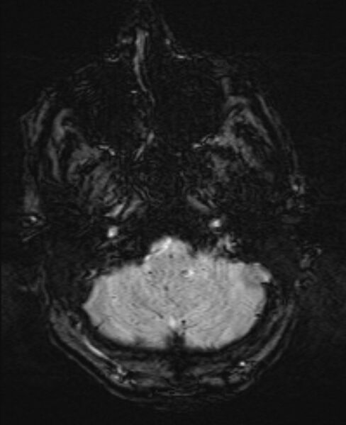 File:Brain metastases - lung cancer primary (Radiopaedia 75060-86115 Axial SWI 10).jpg