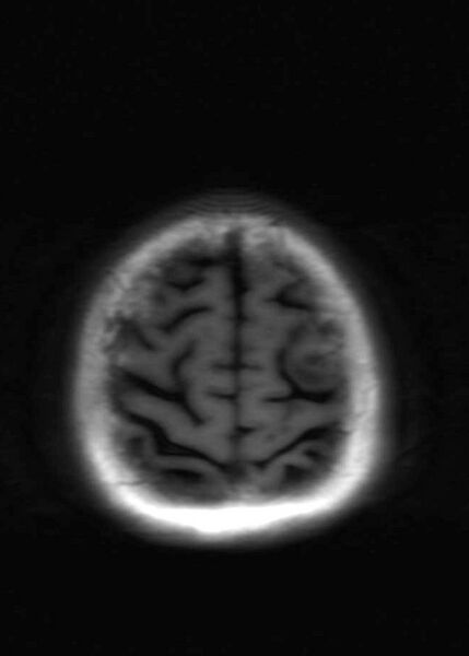 File:Brain metastases from squamocellular lung cancer (Radiopaedia 56515-63222 Axial T1 22).jpg