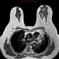 Breast carcinoma (multicentric multifocal in mammary Paget disease) (Radiopaedia 50966-56512 Axial T1 10).jpg