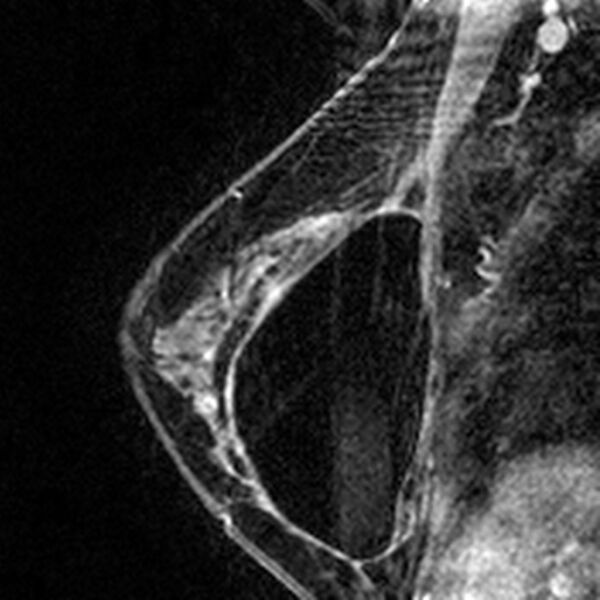 File:Breast implants - MRI (Radiopaedia 26864-27035 Sagittal T2 109).jpg