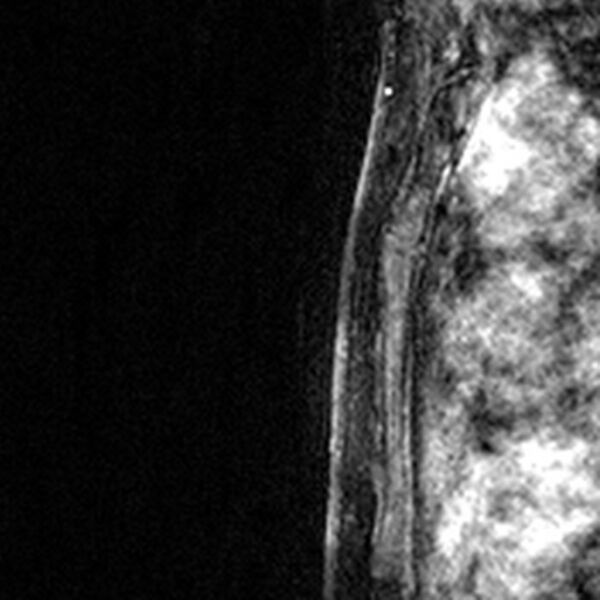 File:Breast implants - MRI (Radiopaedia 26864-27035 Sagittal T2 64).jpg