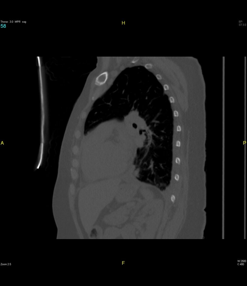 Breast primary with lung and bone metastases (Radiopaedia 40620-43228 Sagittal bone window 58).jpg