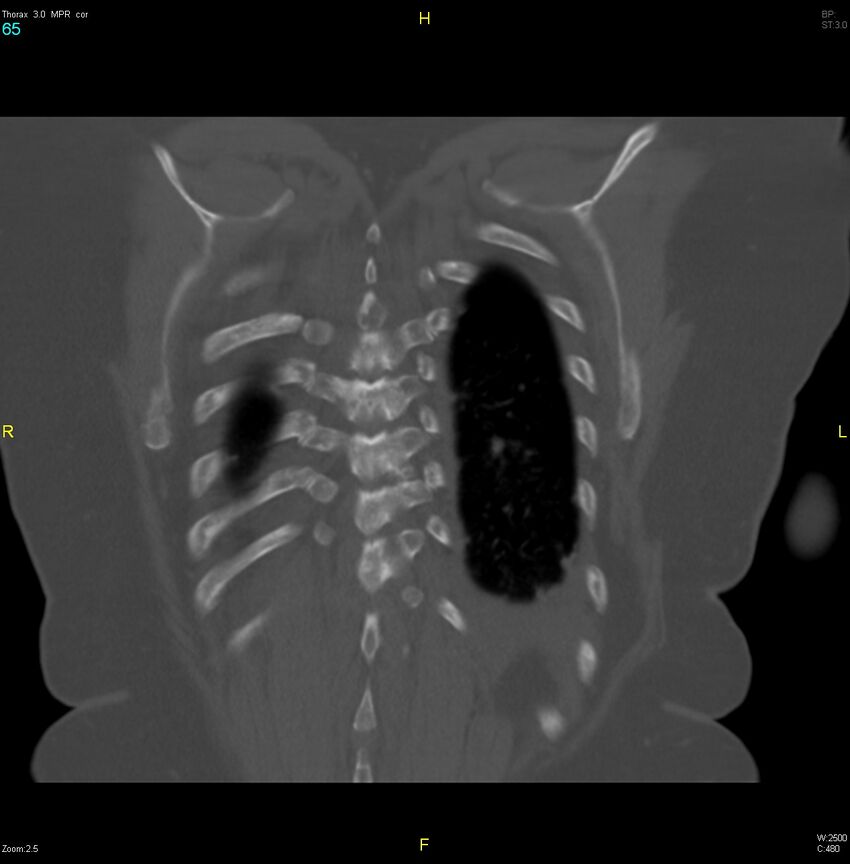 Breast primary with lung and bone metastases (Radiopaedia 40620-43228 bone window 65).jpg