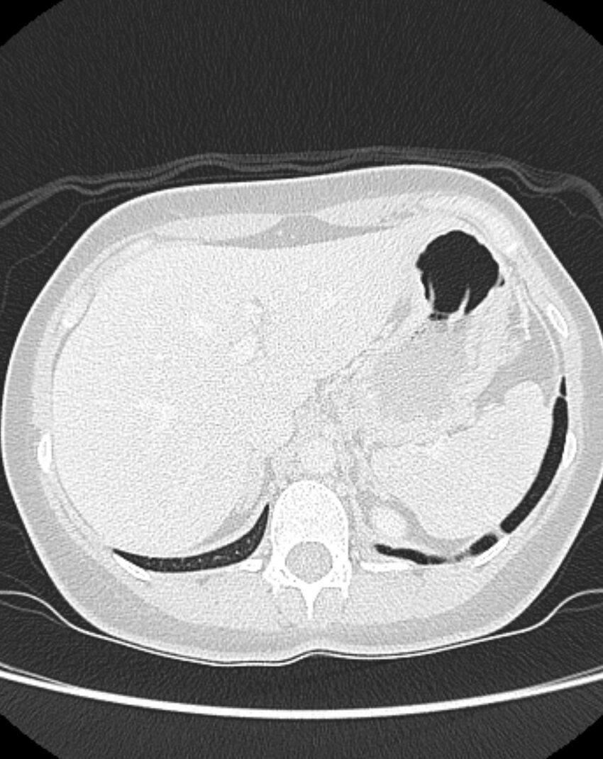 Bronchial atresia (Radiopaedia 50007-55297 Axial lung window 108).jpg
