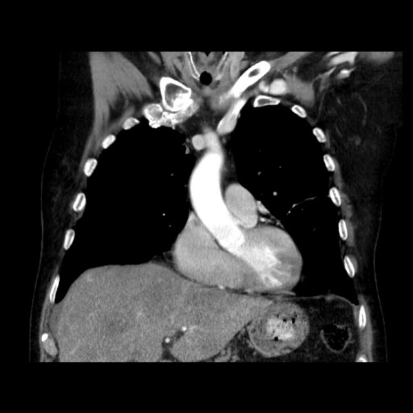 File:Bronchogenic adenocarcinoma and pulmonary embolism (Radiopaedia 9097-9806 C 16).jpg