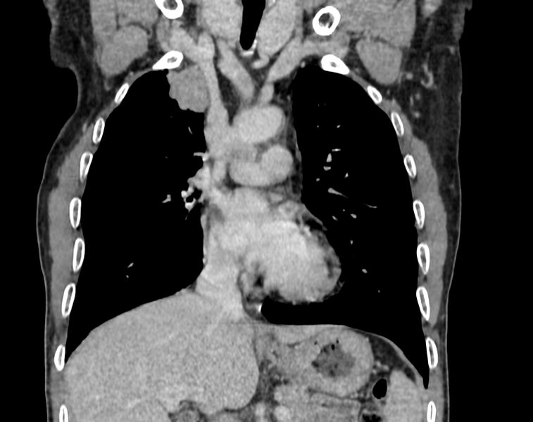 File:Bronchogenic carcinoma with superior vena cava syndrome (Radiopaedia 36497-38054 Coronal C+ delayed 26).jpg
