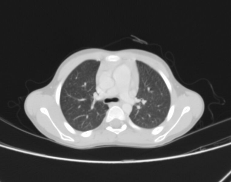 File:Bronchus suis (Radiopaedia 68131-77620 Axial lung window 26).jpg