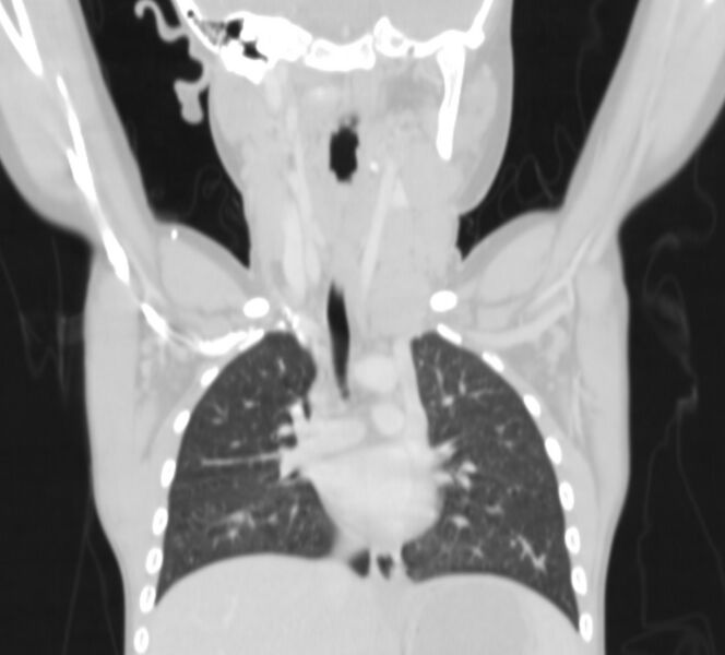 File:Bronchus suis (Radiopaedia 68131-77620 Coronal lung window 2).jpg