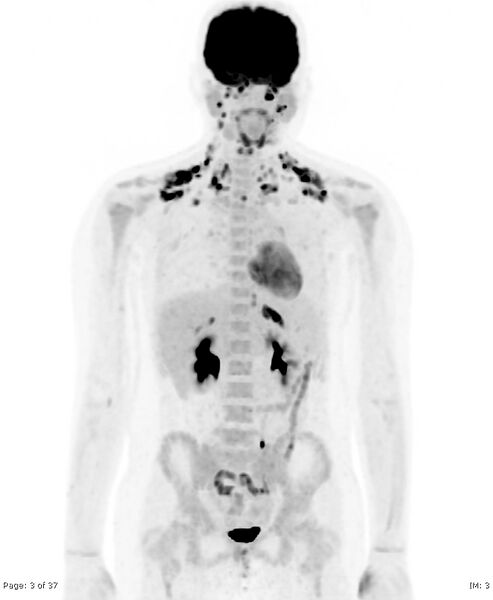 File:Brown fat uptake (FDG PET-CT) (Radiopaedia 77392-89513 MIP 2).jpg