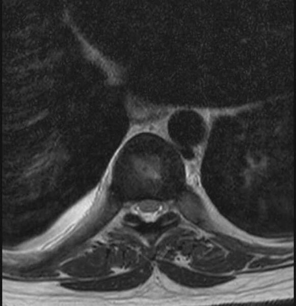 File:Brown tumors compressing the spinal cord (Radiopaedia 68442-78030 A 24).jpg