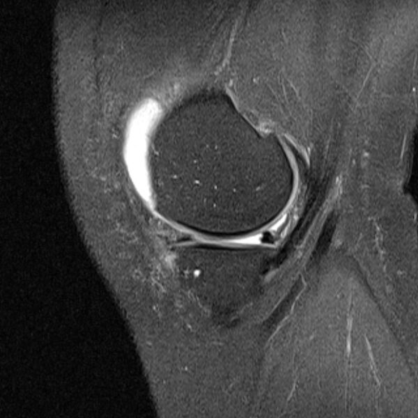 File:Bucket handle tear - medial meniscus (Radiopaedia 79028-91942 Sagittal PD fat sat 20).jpg