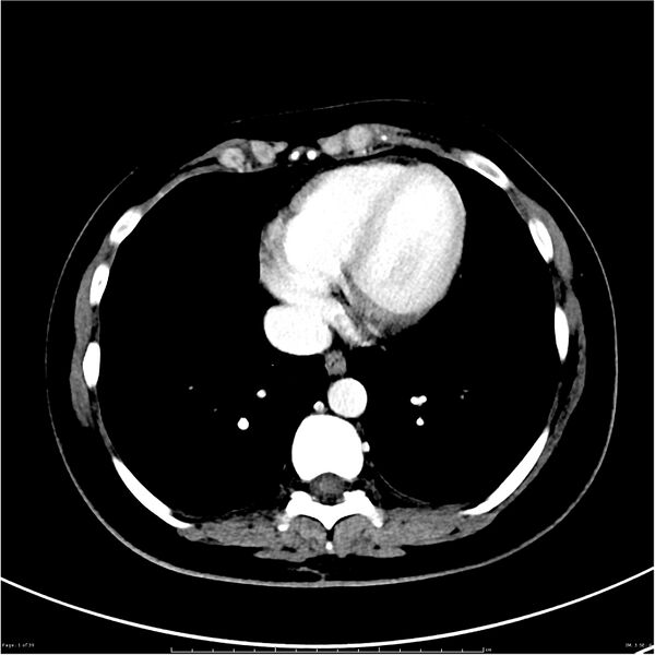File:Budd-Chiari syndrome (Radiopaedia 27929-28177 Axial liver window 1).JPG