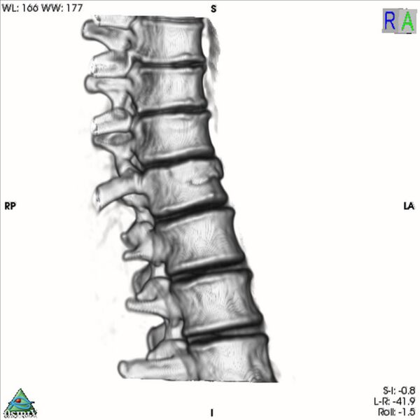 File:Bulging of paraspinal line in traumatic thoracal spinal compression fracture (Radiopaedia 29221-35872 3D VR 5).jpg