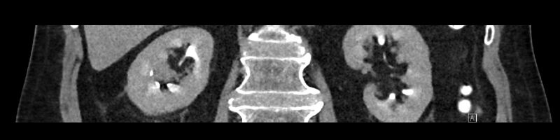 File:Buried bumper syndrome - gastrostomy tube (Radiopaedia 63843-72575 Coronal Inject 64).jpg