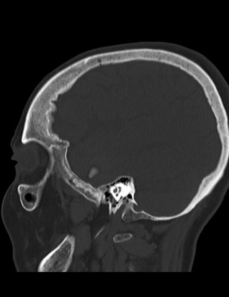 File:Burnt-out meningioma (Radiopaedia 51557-57337 Sagittal bone window 11).jpg