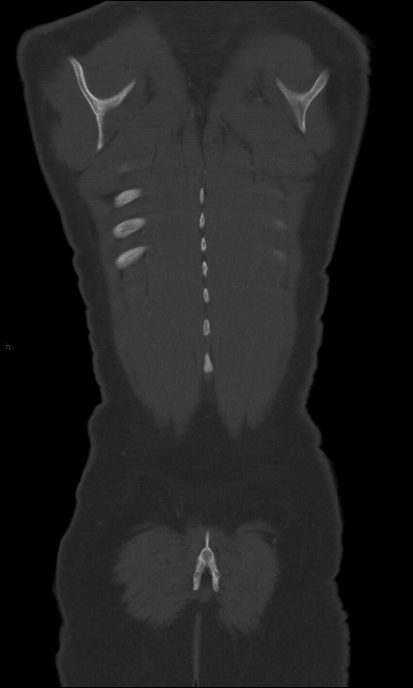 Burst fracture (Radiopaedia 83168-97542 Coronal bone window 67).jpg